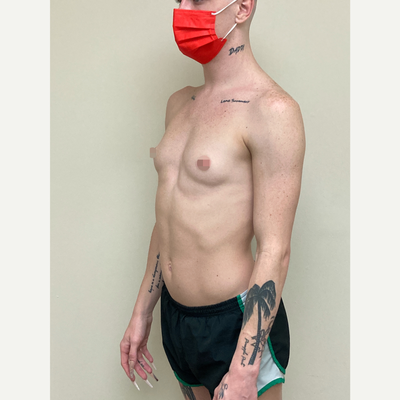Transgender-Breast-Augmentation-before-11790222-5030227.jpg